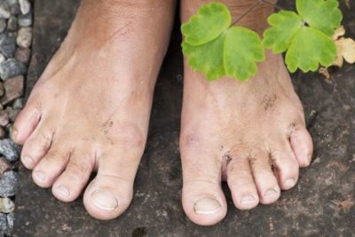 Moberg Pharma rusar på godkänd nagelsvampsbehandling