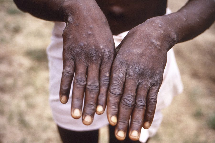 Moderna börjat utveckla vaccin mot apkoppor - Europe-Monkeypox