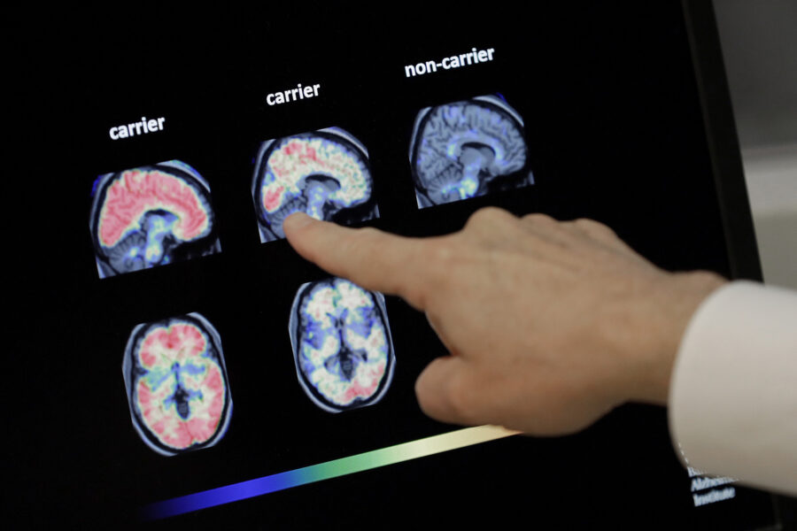 Roche inleder Alzheimersamarbete med Eli Lilly - Alzheimer Roche Eli Lily